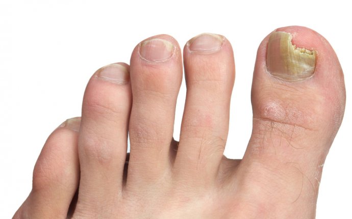 Nail Problems - Australian Podiatry Association