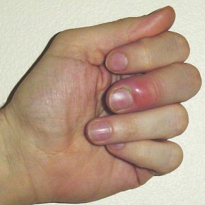 Paronychia (infection of the skin around the nails)