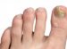 Problems of nails