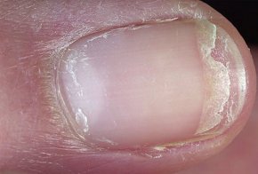 split fingernail
