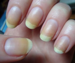 Stained nails (source: 